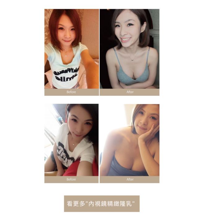 隆乳手術前後對比圖 隆乳心得-隆乳手術前後對比圖