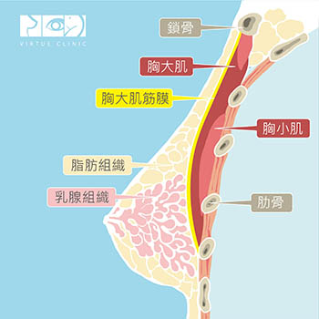 隆乳的義乳置放位置 隆乳的義乳置放位置