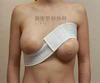 隆乳手術後使用S型束胸帶綁法 隆乳手術後使用S型束胸帶綁法