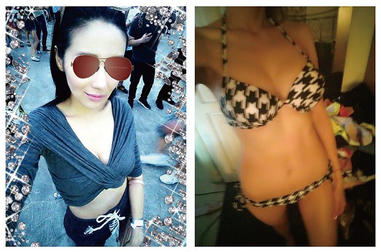 水滴形內視鏡隆乳手術後 水滴形內視鏡隆乳手術後